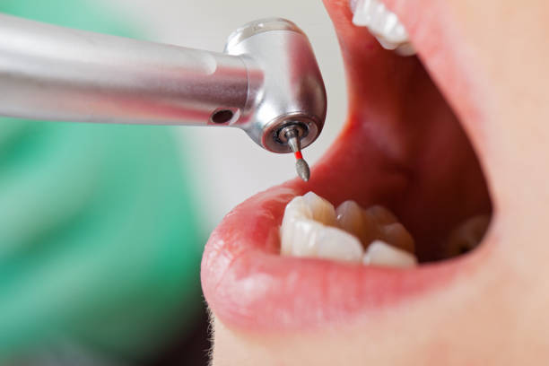 Best Emergency Dentist for Lost Fillings or Crowns in Beggs, OK